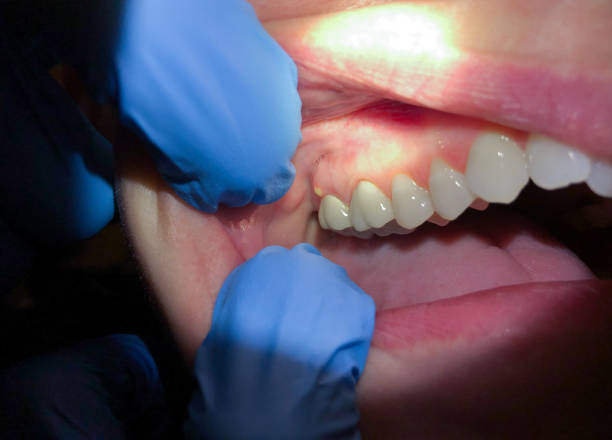 Best Emergency Dental Care for Broken or Chipped Teeth in Niagara, WI